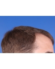 Before Hair Transplant&nbsp;Hairlines
